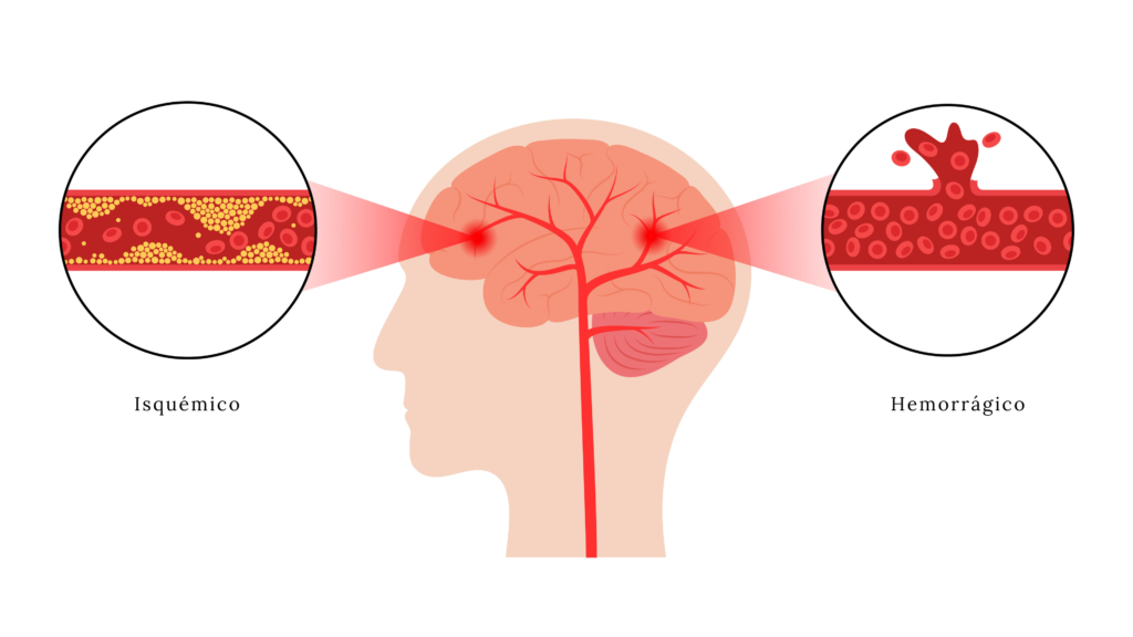 Tipos de Acidente Vascular Cerebral