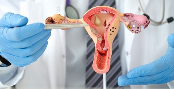 O que é a endometriose, quais os seus sintomas e tratamento?